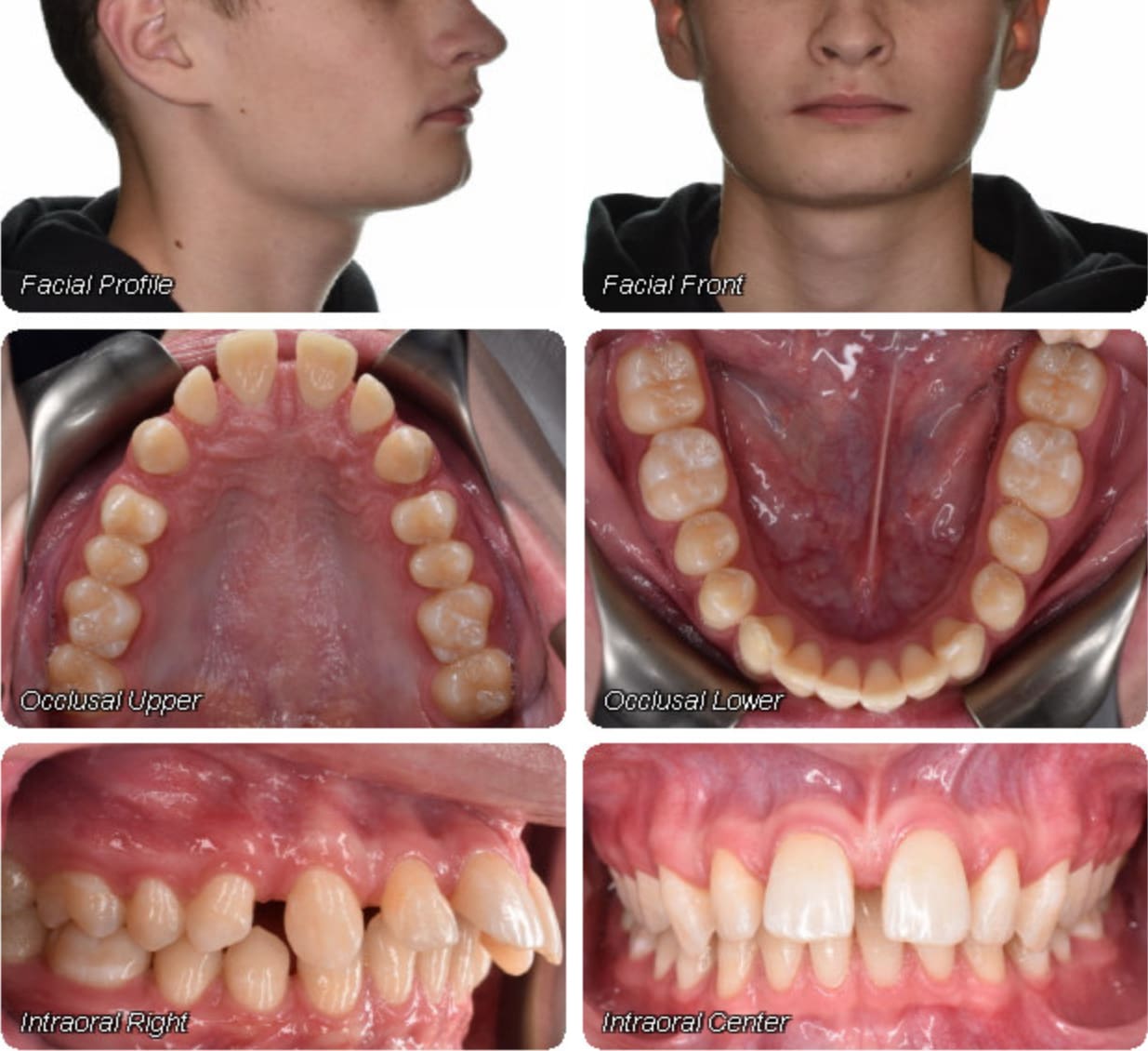At Wink Orthodontics in Prosper, TX, a set of six dental images displays a male patient's facial profile and front view, along with upper and lower occlusal, right intraoral, and center intraoral photos taken before braces.