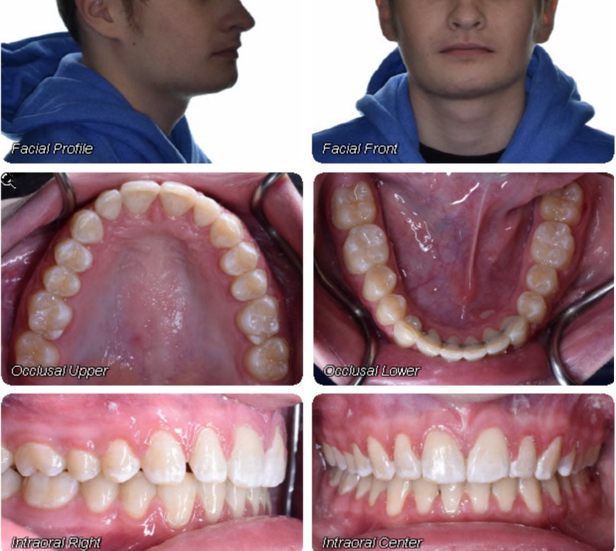 At Wink Orthodontics in Prosper, TX, four intraoral images display the progress of braces on upper and lower teeth from occlusal and side views, featuring blue elastic ligatures securing the wires as patients work toward confident smiles.