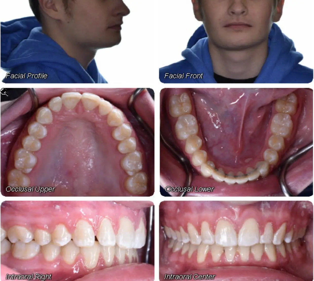 At Wink Orthodontics in Colleyville, TX, four intraoral photos—upper and lower occlusal, right side view, and center front view—are ideal for tracking your teeth’s progress before and after braces.