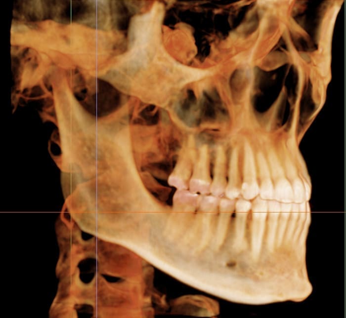 Dr. Mohammed Al-Zainal and Dr. Mo Idilbi: Orthodontist in Prosper TX Side profile 3D X-ray of a skull and jaw showing teeth and bone at Wink Orthodontics in Prosper, TX.