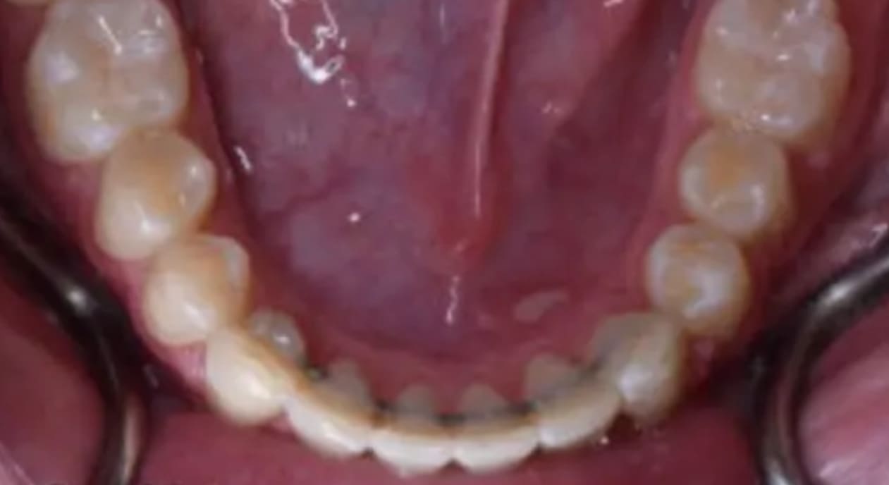 Lower jaw close-up showing teeth and a lingual wire retainer after braces at Wink Orthodontics in Colleyville, TX.