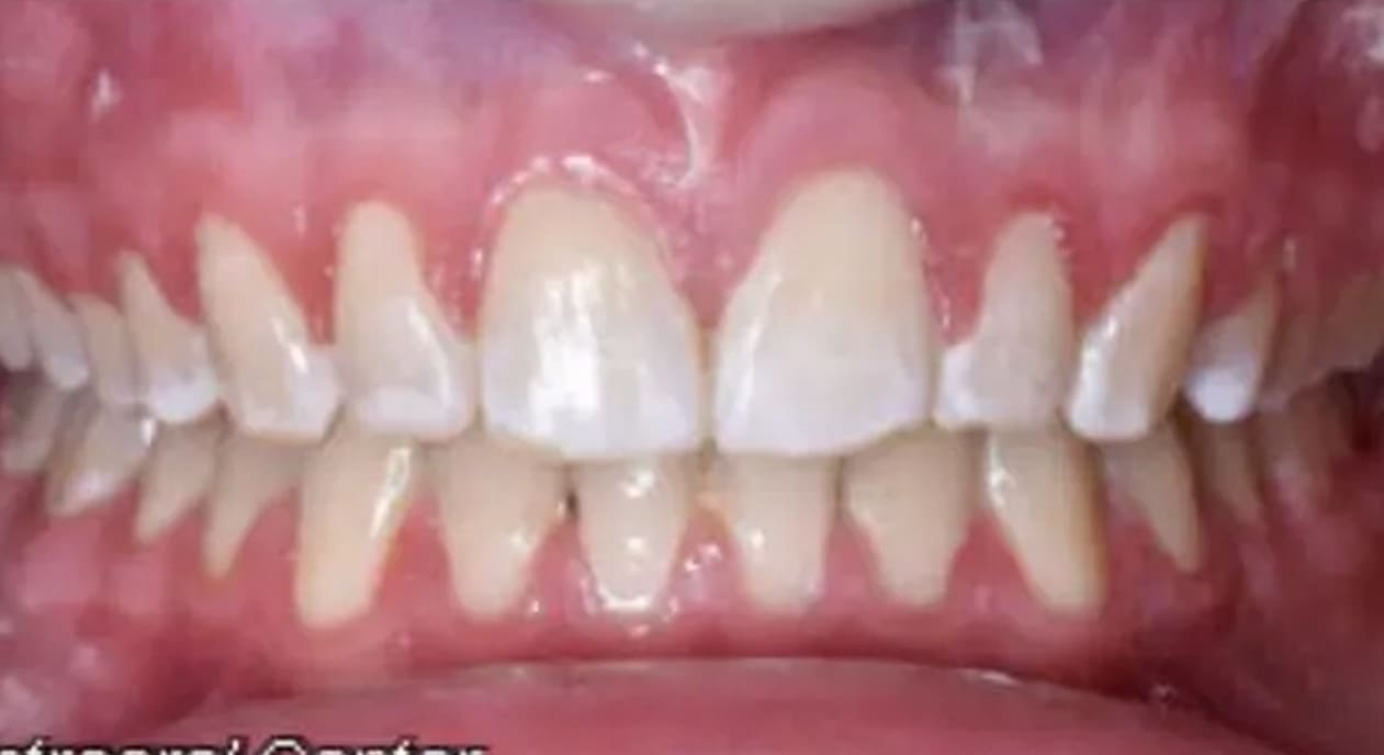 After braces, teeth remain visibly crooked with gum recession, highlighting misalignment treated by Wink Orthodontics in Prosper, TX.