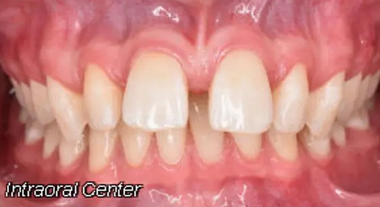 A close-up of teeth showing spacing and mild crowding, gums visible; Wink Orthodontics in Prosper, TX.