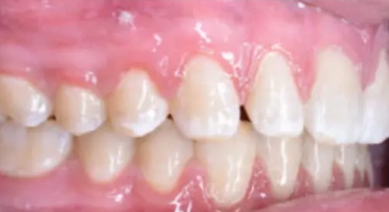 Perfectly aligned teeth and healthy pink gums after braces at Wink Orthodontics in Prosper, TX.