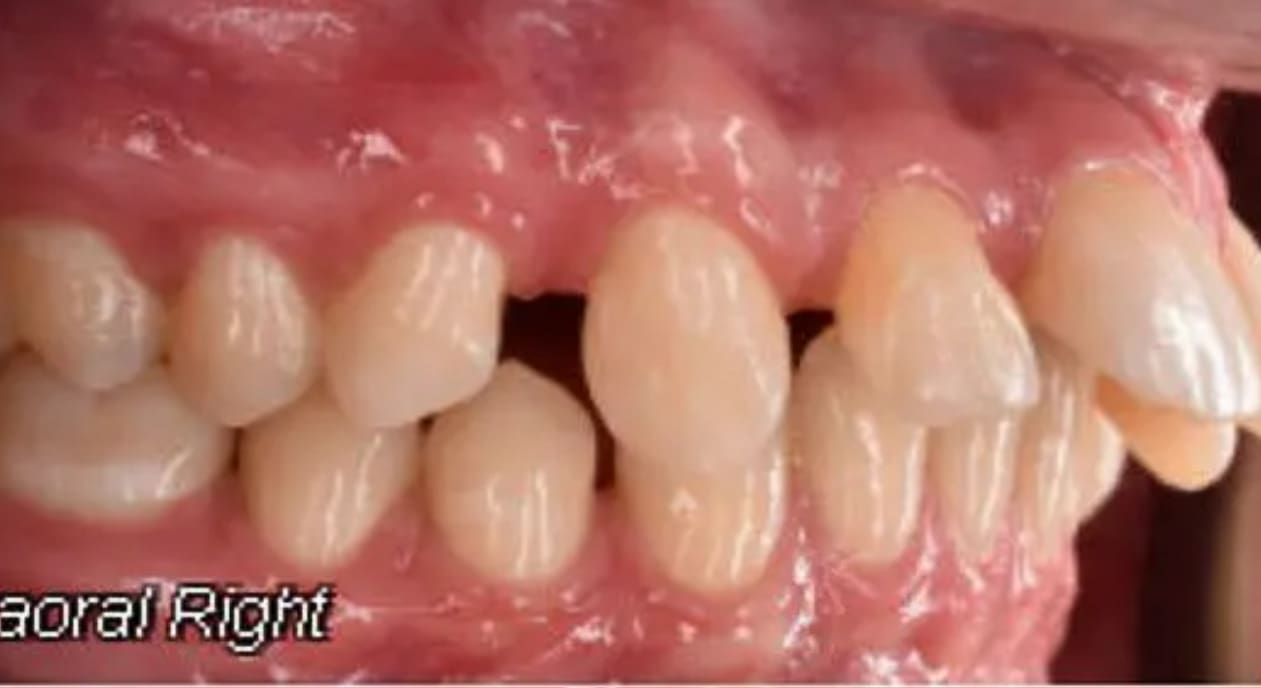 Dental crowding and overbite before braces at Wink Orthodontics in Prosper, TX; gums and mouth visible.