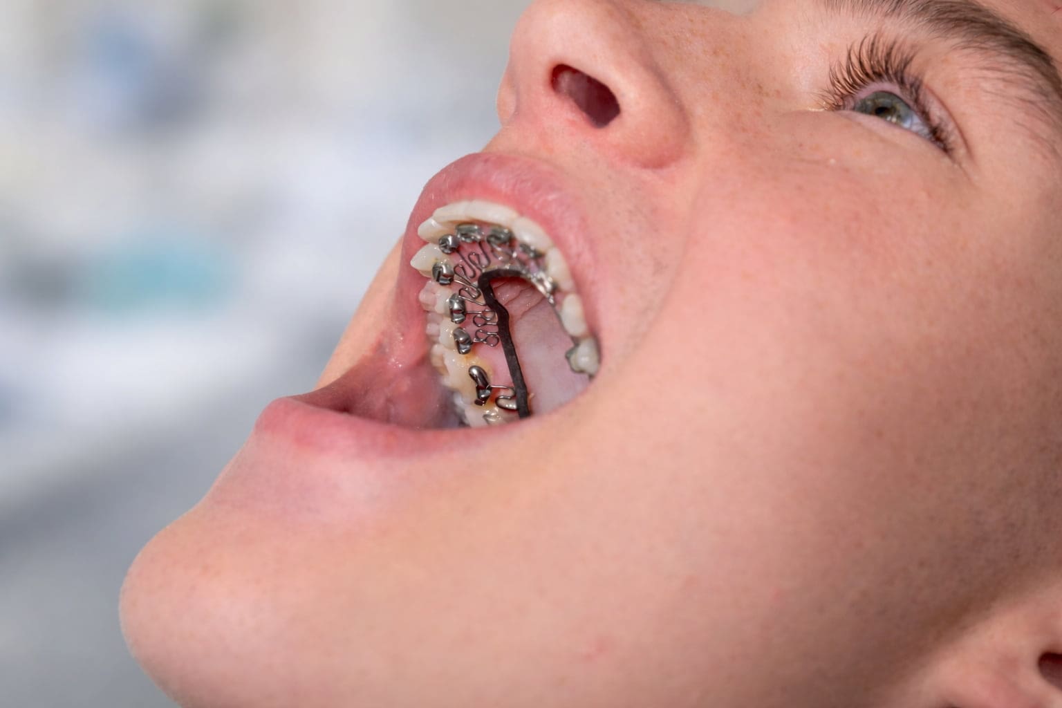 A person opens their mouth to reveal Brava Braces from Wink Orthodontics in Prosper or Colleyville, TX on upper and lower teeth.