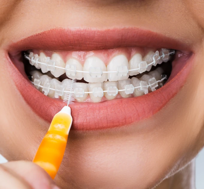 A person with 3D Printed Braces cleans their teeth using an interdental brush at Wink Orthodontics in Prosper or Colleyville, TX.