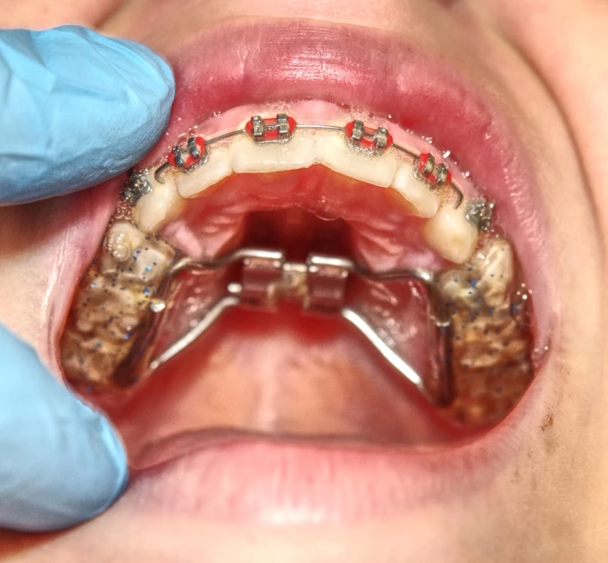 At Wink Orthodontics in Prosper or Colleyville, TX, close-up of an open mouth with Brius braces and a palatal expander visible.