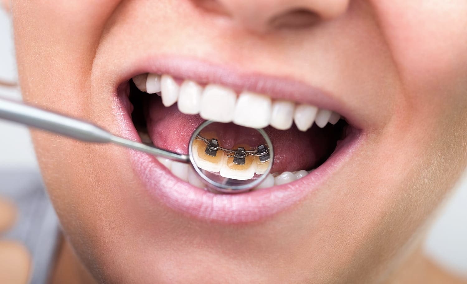 A dental mirror and tool reveal lingual braces on a patient’s teeth at Wink Orthodontics in Colleyville, TX.