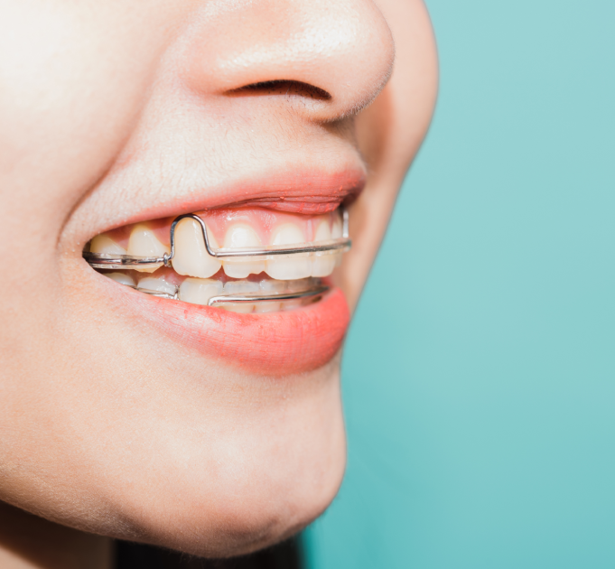 Custom Fixed Retainers