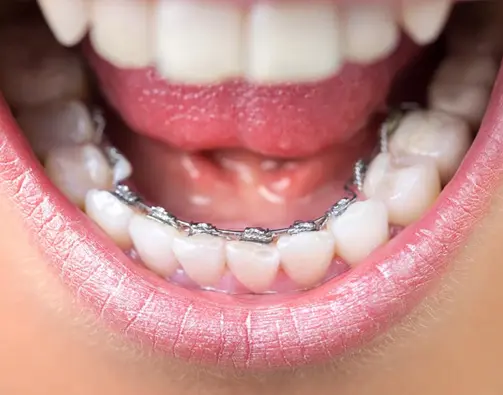 Lingual Braces