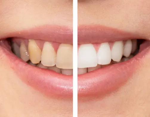 Teeth Whitening