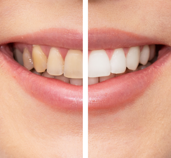 teeth whitening